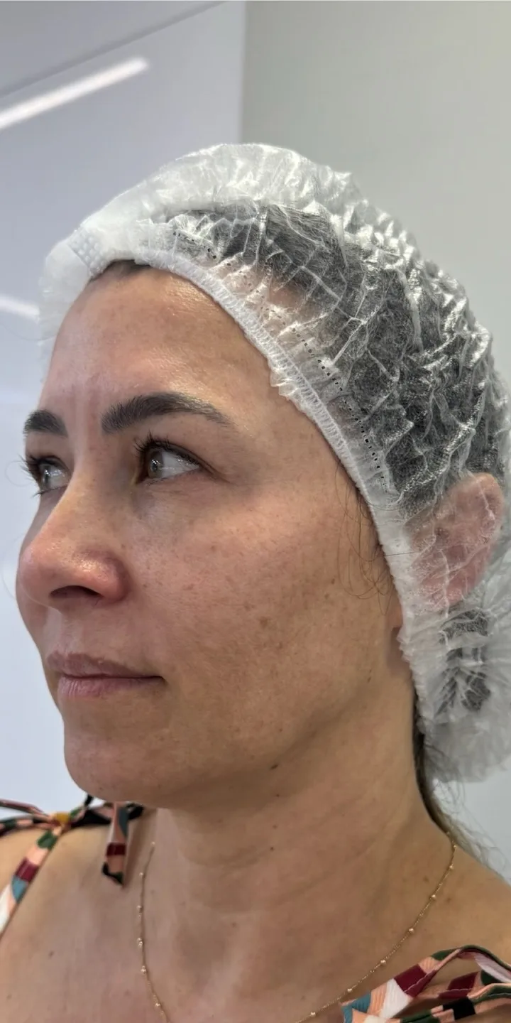 Antes do Sculpt Face Lift