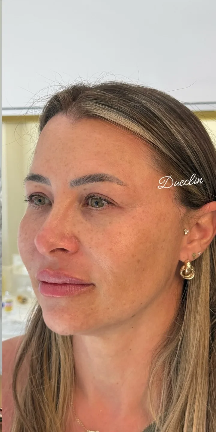 Depois do Sculpt Face Lift