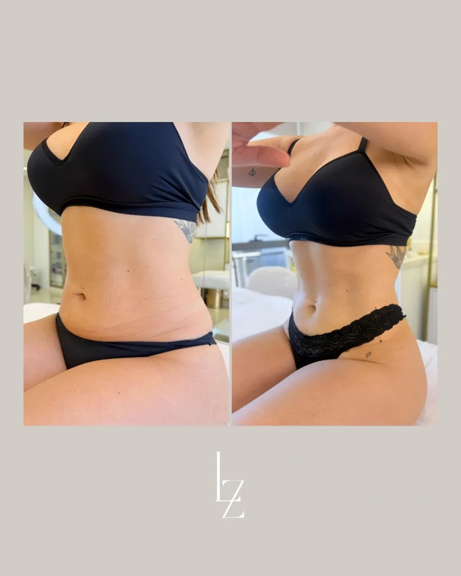 Resultado CrioSculpt Dra. Luana