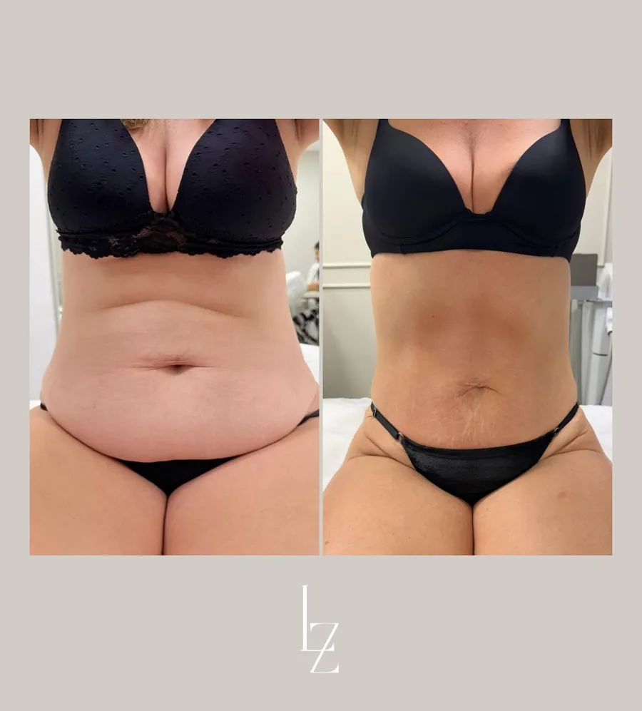 Resultado CrioSculpt