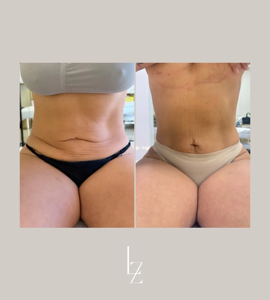 Resultado CrioSculpt