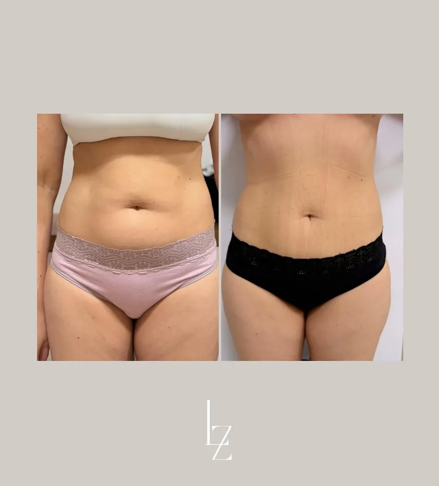 Resultado CrioSculpt
